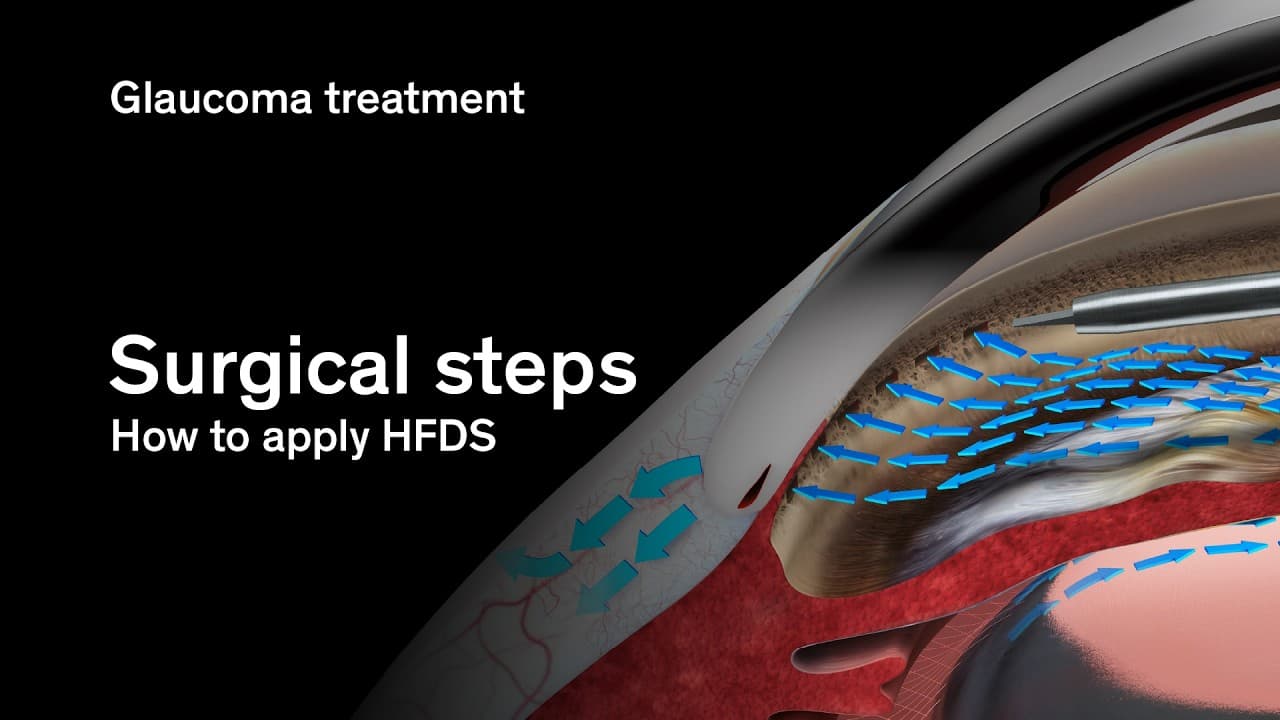 Spotlight: The HFDS procedure | Glaucoma treatment
